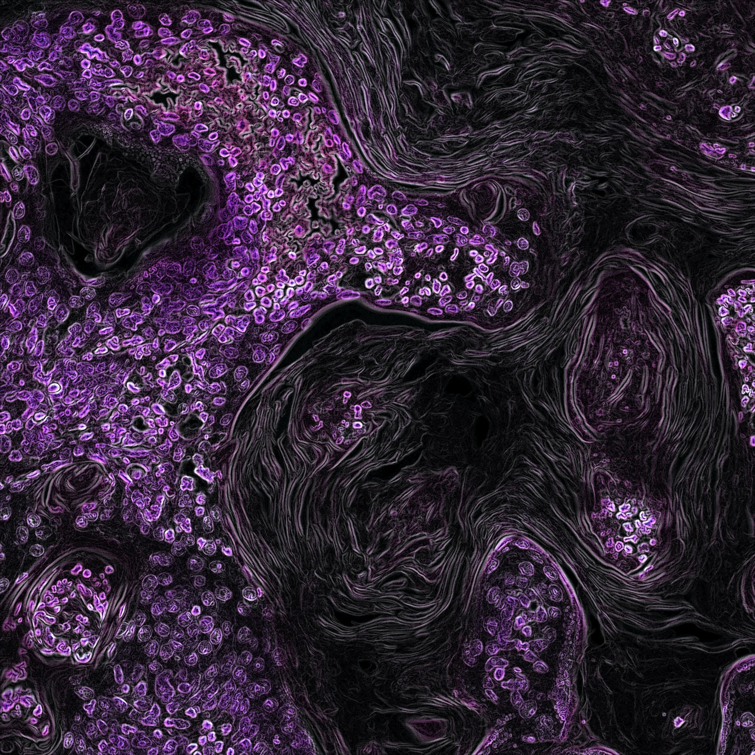 A close-up image of lung cancer shows masses of irregular oval cells clustered beside swirls of long, thin cells.